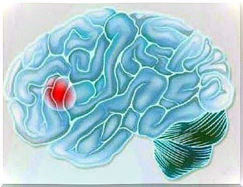 Types of Strokes